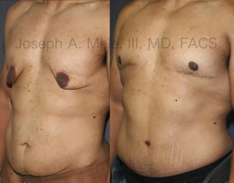 Cirugía Bariátrica: ¿Salud o Estética?