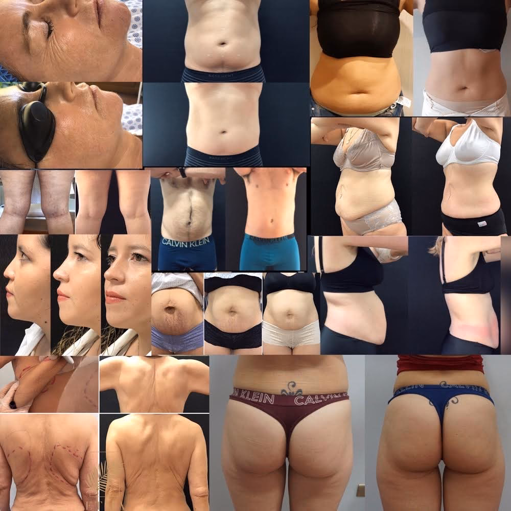 ¿Qué es la fisioterapia en cirugía plástica?