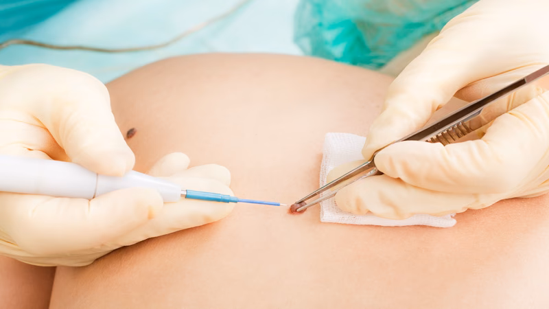 ¿Cuáles son las cirugías dermatológicas?