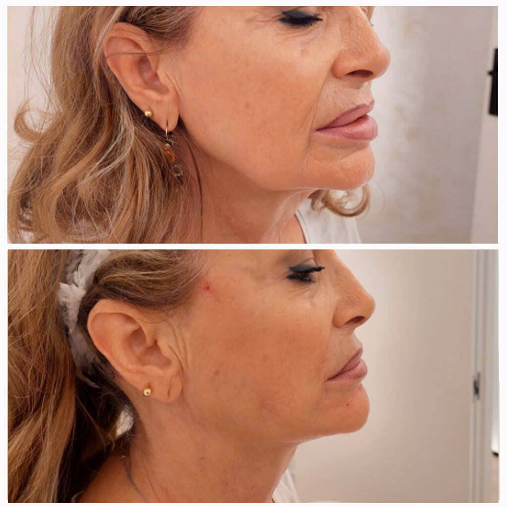 ¿Cuánto cobran por poner hilos tensores?