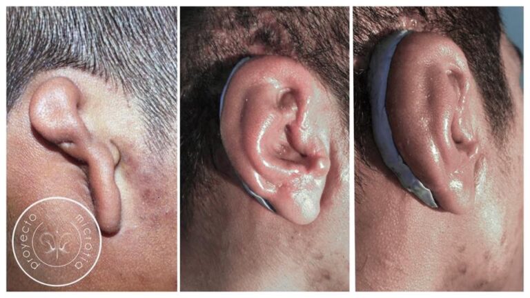Cirugía de Microtia: Opciones y Soluciones