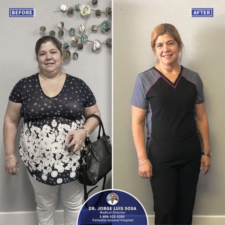 Dr. Sosa: Cirugía Bariátrica de Vanguardia en Miami