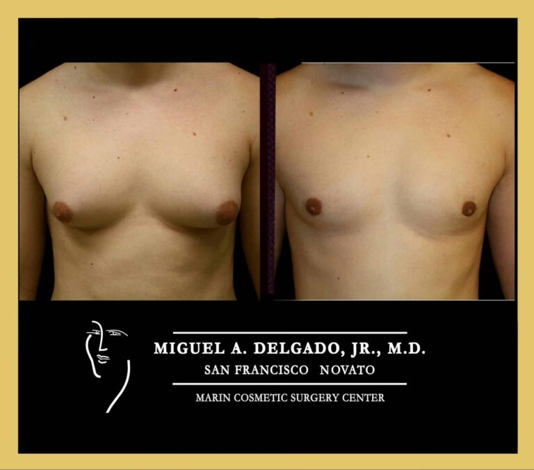 Ginecomastia: ¿Qué Especialista Debo Consultar?