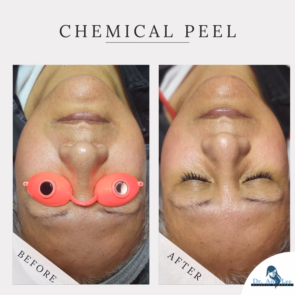 ¿Cuánto cuesta una lipoescultura en El Paso, TX?