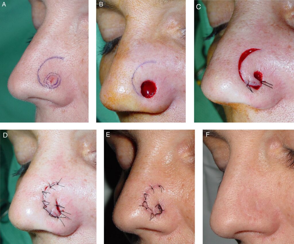 Cirugía de Colgajo Nasal: Guía Completa