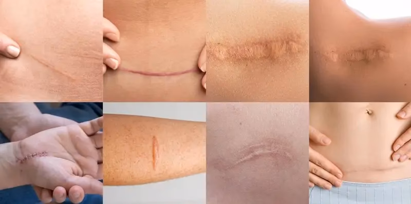 ¿Qué pomada sirve para borrar cicatrices?