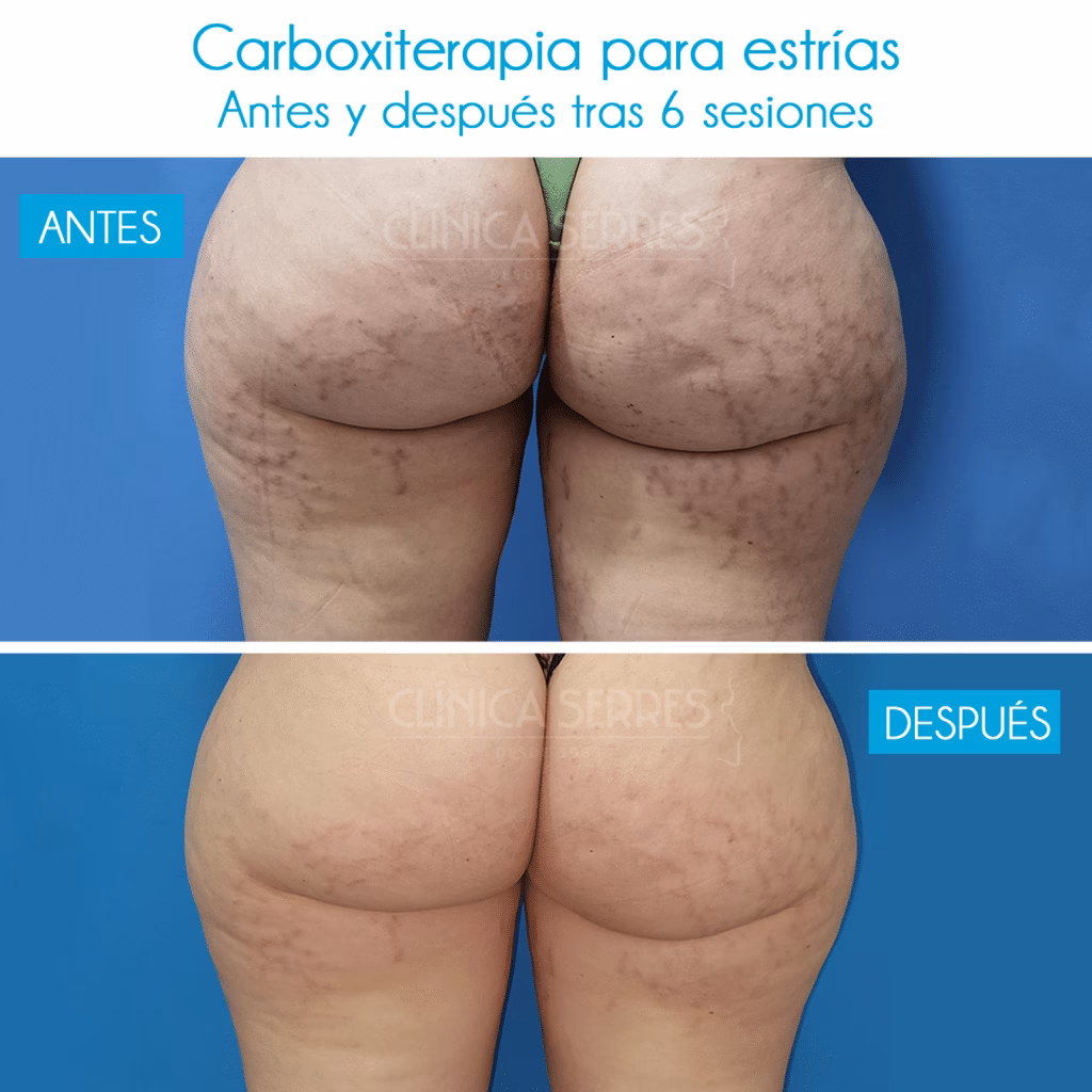 ¿Cómo se llama la cirugía para eliminar las estrías?