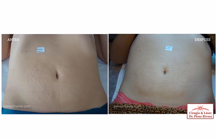 ¿Cuánto cuesta una cirugía para quitar estrías?