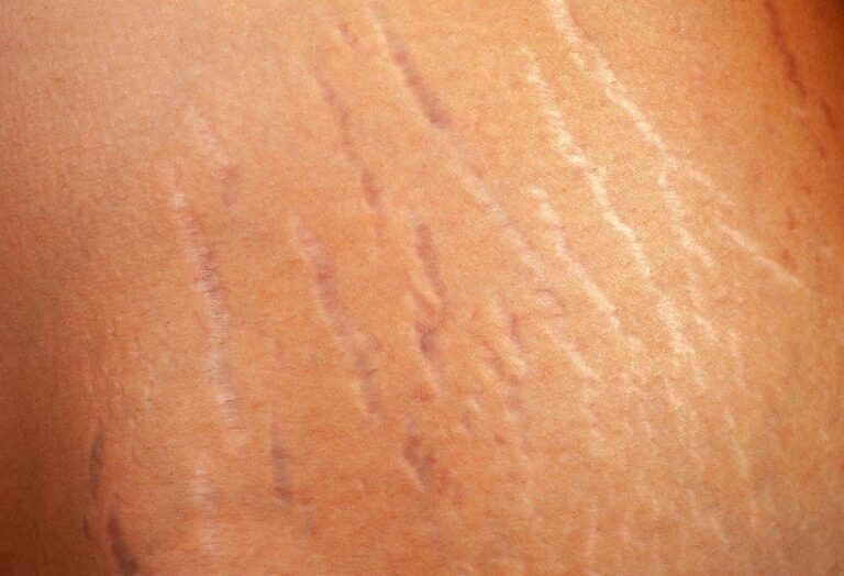 Cirugía Plástica para Eliminar Estrías: La Guía