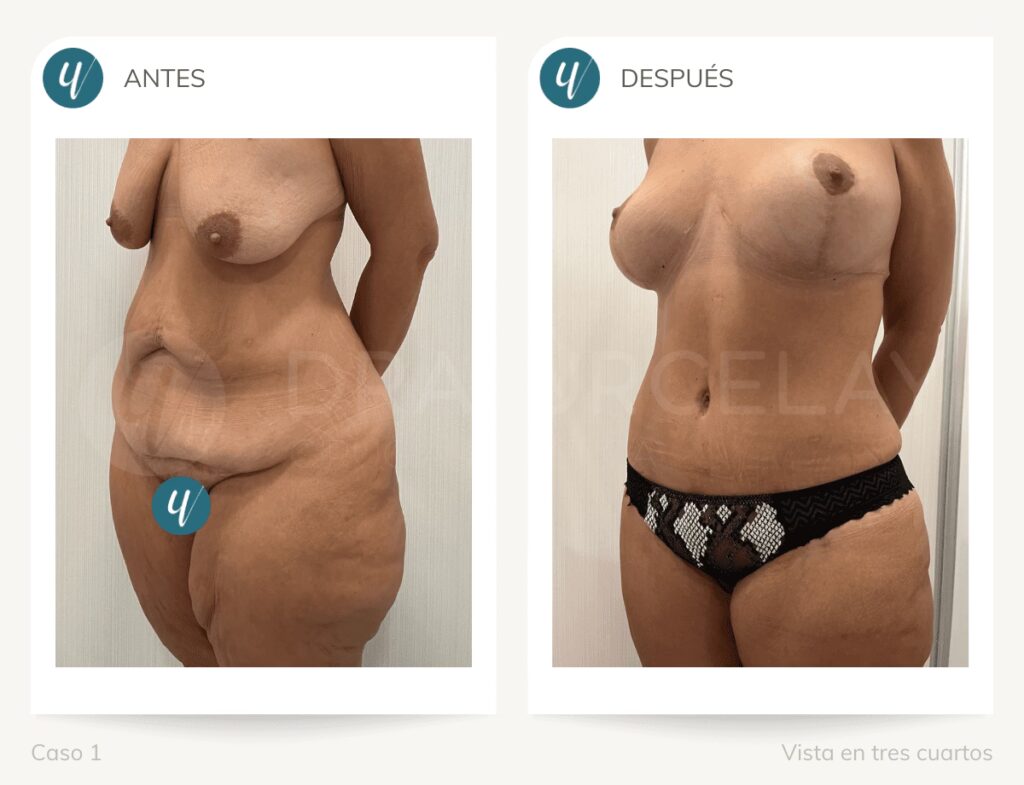 Recuperación de una Reducción de Senos: Guía Completa