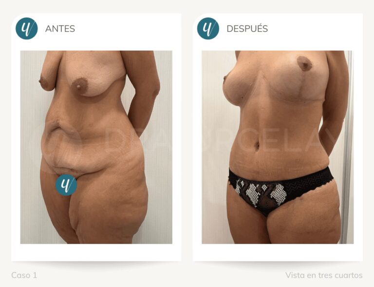 Reducción Mamaria: ¿Cuál es la Talla Ideal?