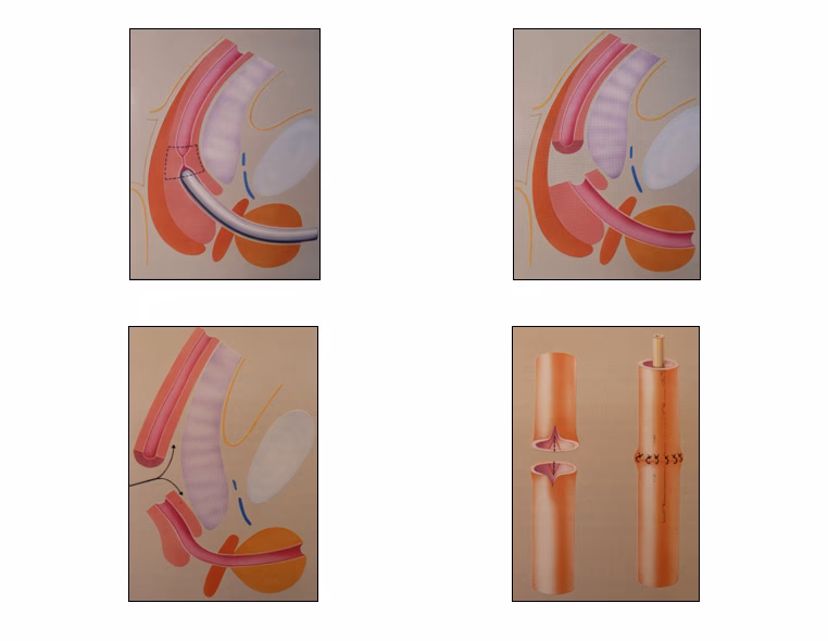 Uretroplastia: Guía Completa de Reparación Uretral