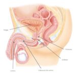 Uretroplastia Fallida: ¿Cuáles son los Pasos a Seguir?