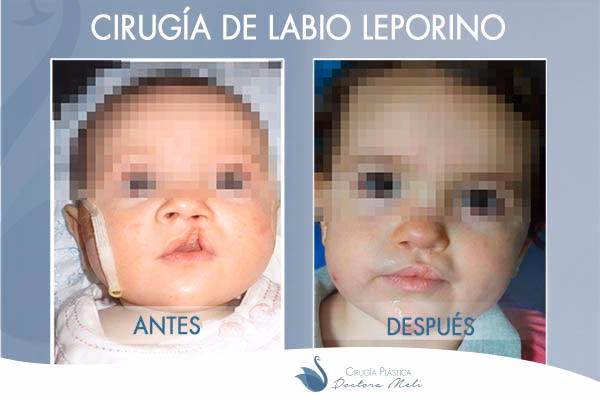 ¿Cómo se realiza una cirugía para el paladar hendido?