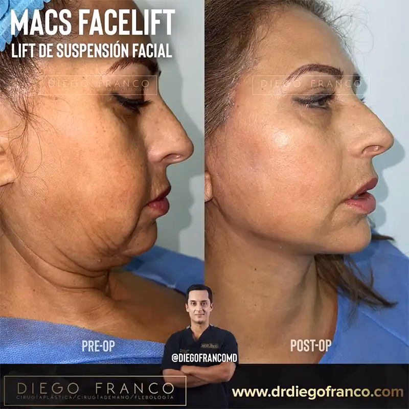 ¿Quiénes son los mejores cirujanos de nariz en Pereira?