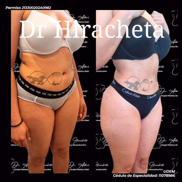 ¿Cuánto cuesta una lipoescultura en Chihuahua?