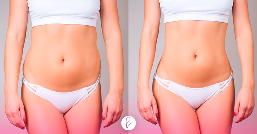 ¿Cuánto cuesta una lipo láser en Perú?