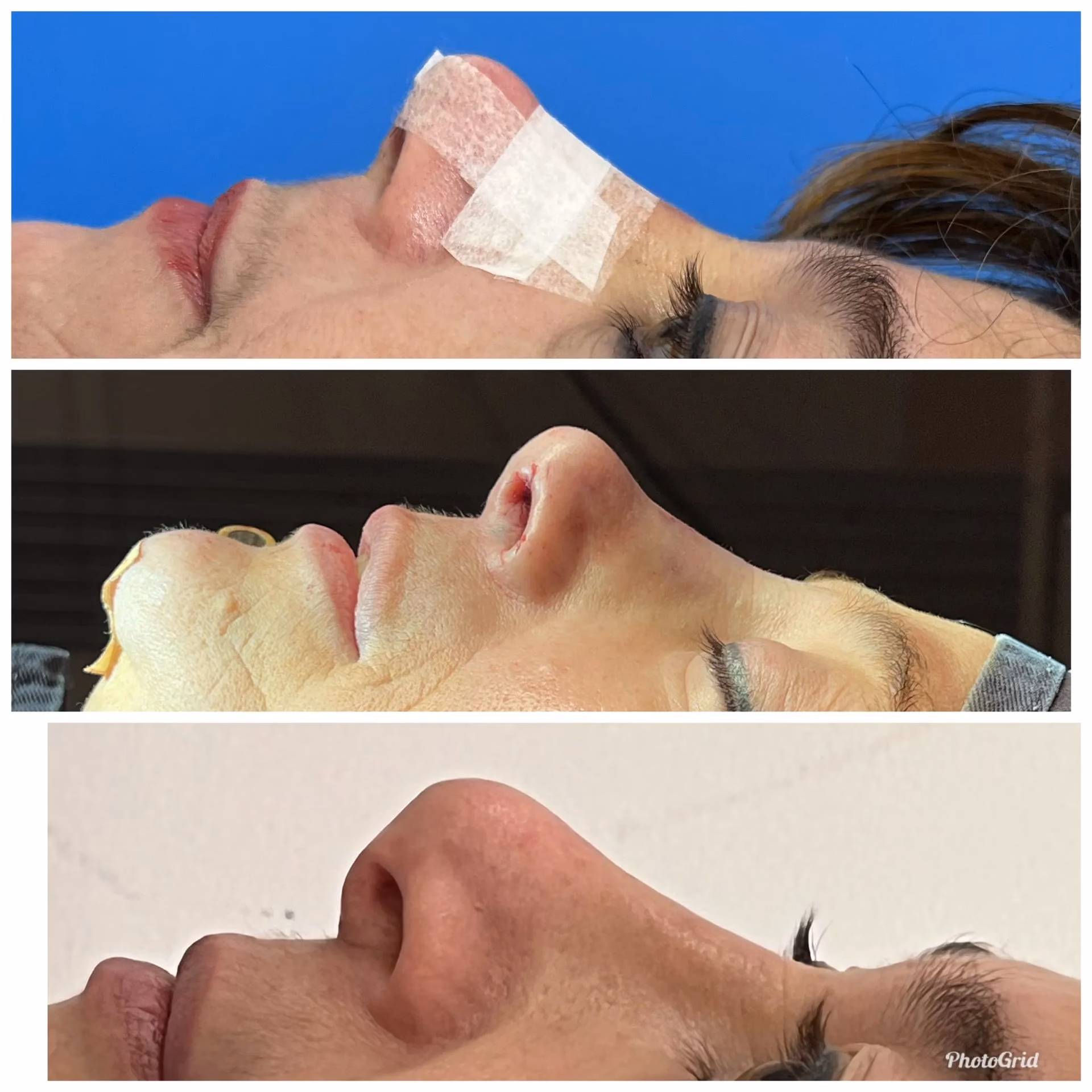 ¿Cuál es el costo de una abdominoplastia en Uruguay?