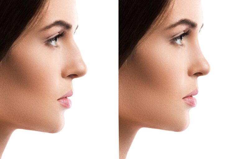 Costo de una Rinoplastia con el Dr. Paul Nassif