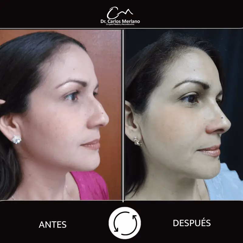 ¿Cubre la EPS la rinoplastia en Colombia?