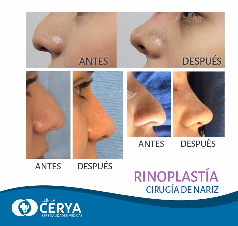 Rinoplastia en México: ¿Es una Decisión Segura?