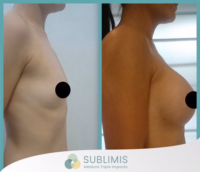 ¿Cuál es el mejor país para hacerse un lifting de pecho?