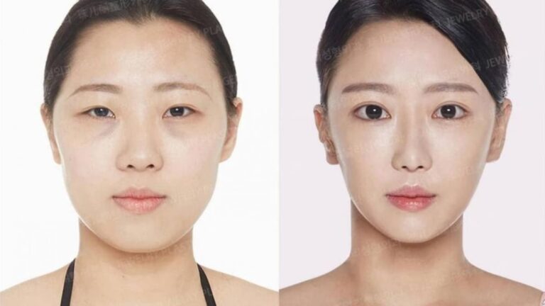 Cirugía Plástica en Corea del Sur: Guía de Seguridad