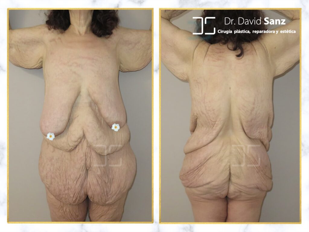 Costo de Cirugía Plástica Post Pérdida de Peso