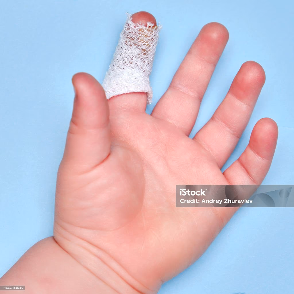 ¿Se puede reimplantar un dedo cortado?