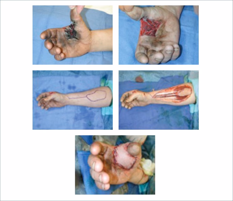 ¿Cuánto tarda en sanar una reconstrucción de dedo?