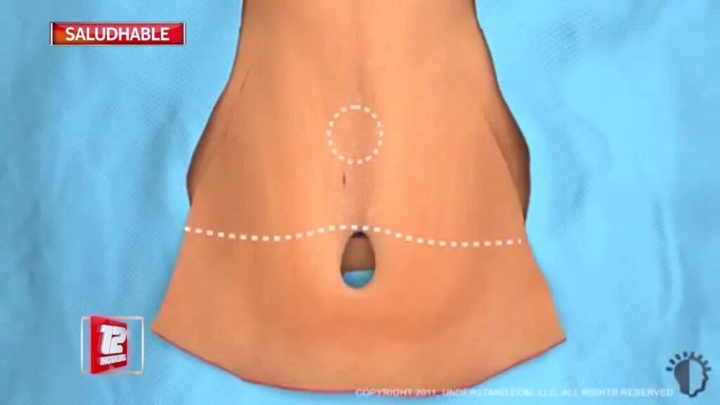 Dermolipectomía: Guía Completa y Resultados
