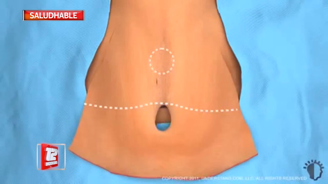 ¿Qué es una dermo cirugía?