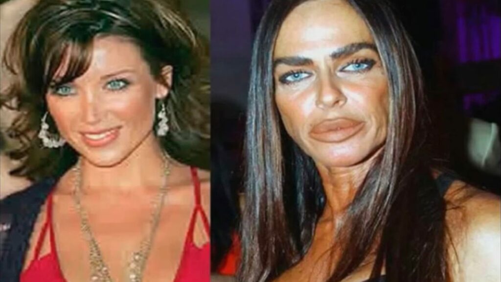 Riesgos y Consecuencias de la Cirugía BBL