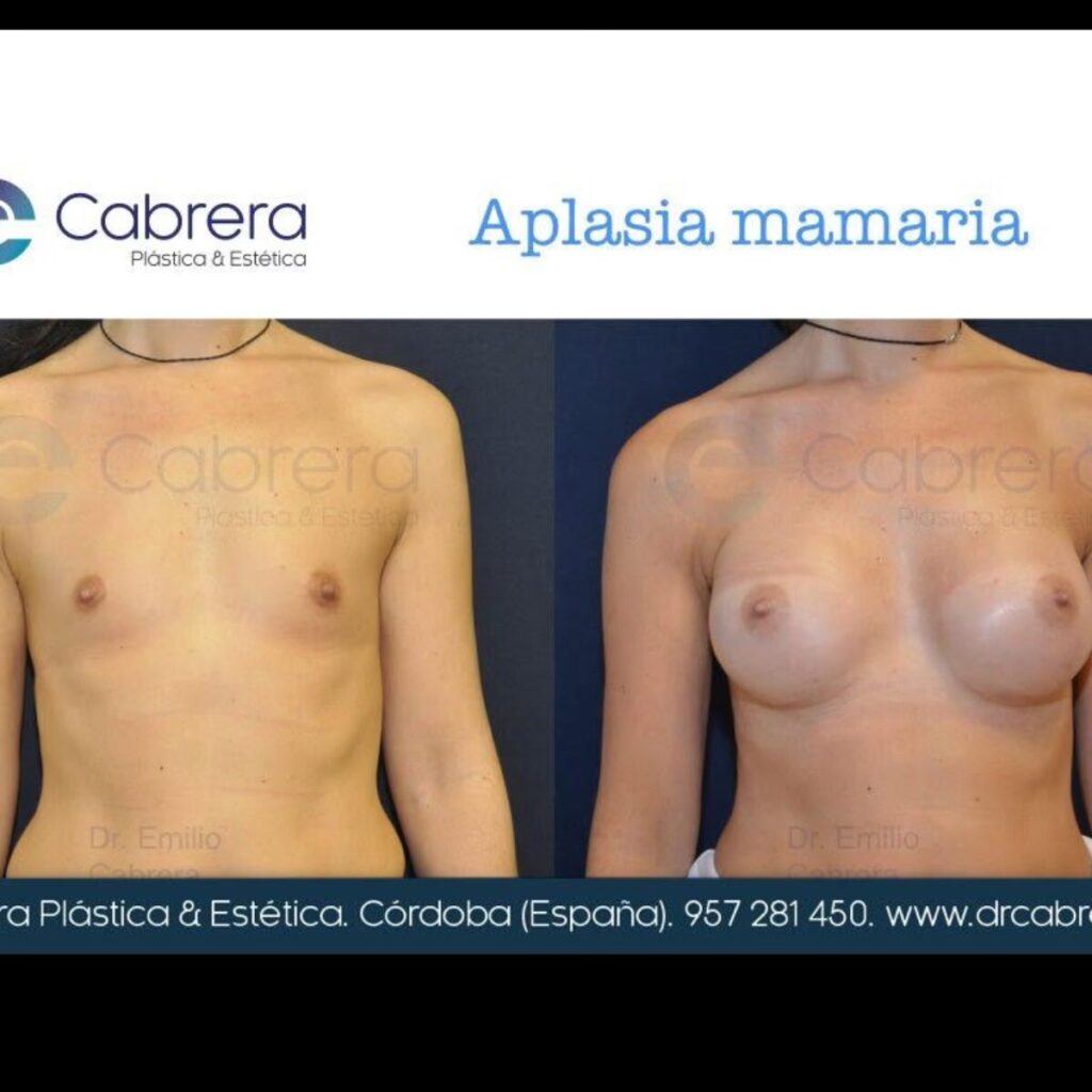 Displasia Mamaria: ¿Es la Cirugía una Solución?