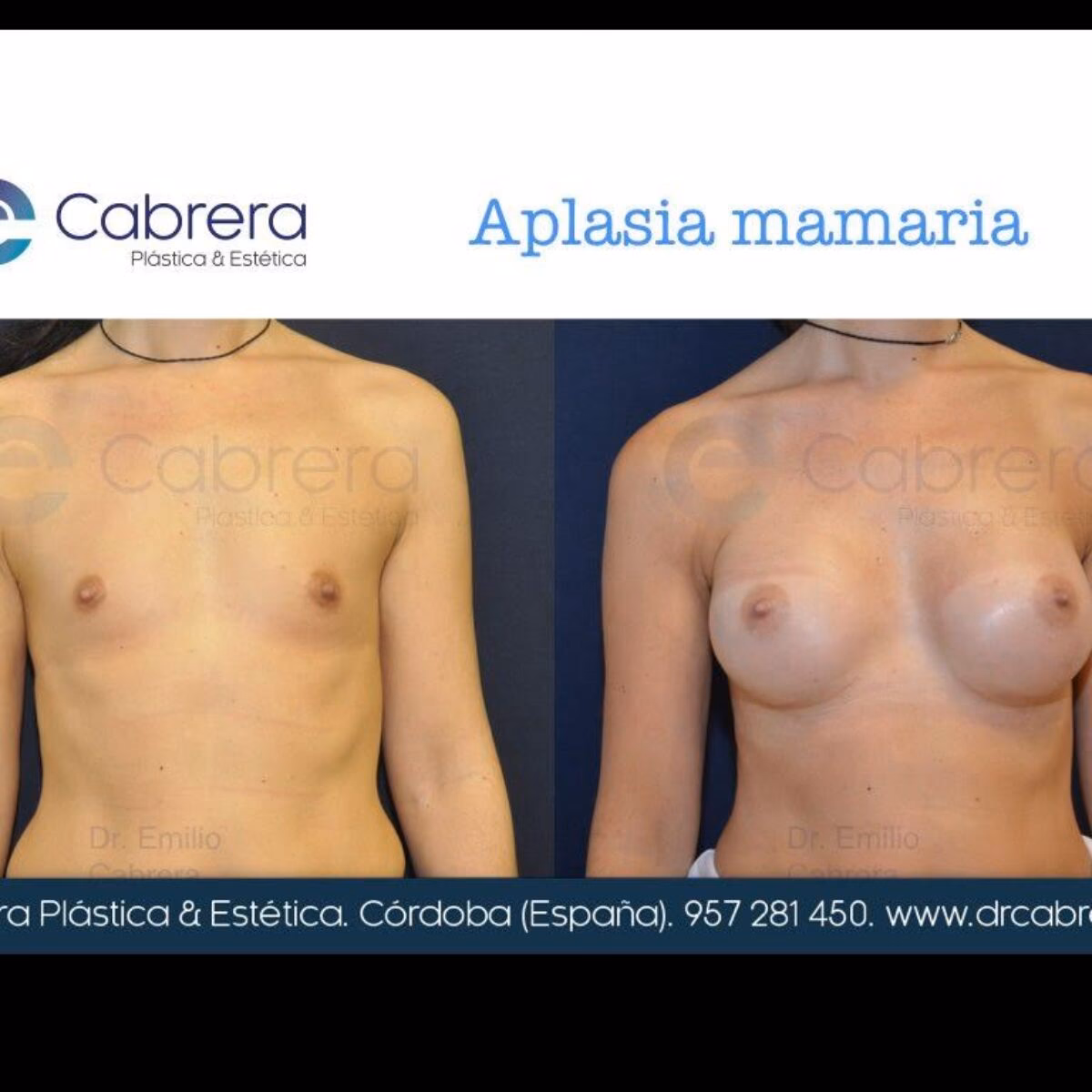 ¿Cómo se puede corregir la displasia mamaria?