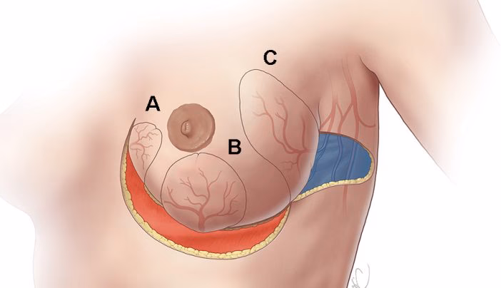 ¿La displasia mamaria se opera?