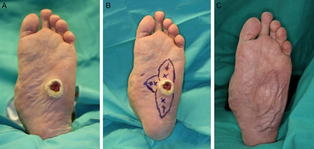 Dolor de Pie Post-Cirugía: ¿Cuándo Preocuparse?