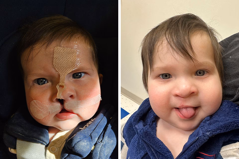 ¿Se puede operar el paladar hendido en adultos?