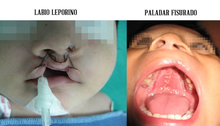 Cirugía de Labio Leporino: Una Guía para Padres