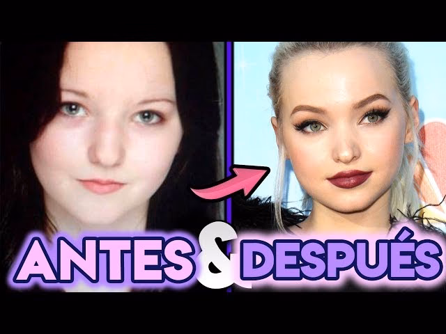 Dove Cameron: Análisis de sus Cirugías Plásticas