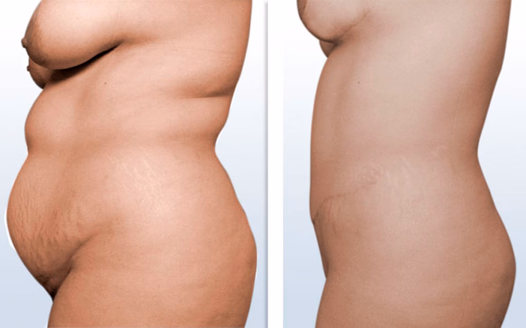 ¿Qué pasa si me embarazo después de una cirugía?