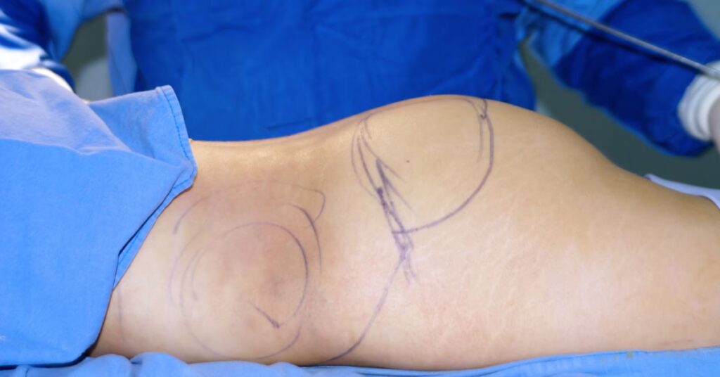 Embolia Grasa: El Riesgo Oculto de la Liposucción