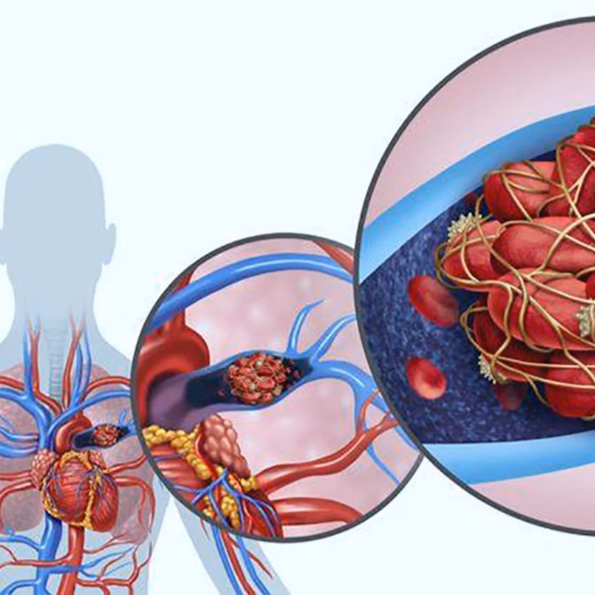 ¿Cómo evitar la embolia pulmonar en cirugía plástica?