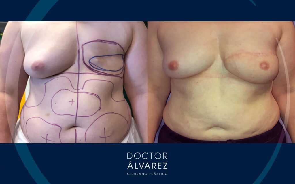 Reconstrucción Mamaria: Costos y Opciones