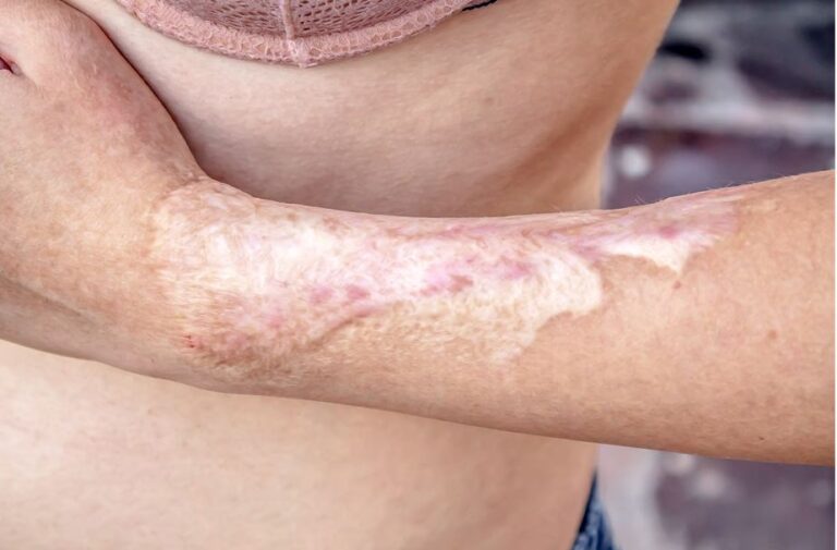 Dermocirugía: La Cirugía de la Piel al Detalle