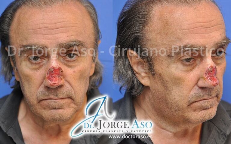 Costo de Rinoplastia por Nariz Rota: Guía 2024