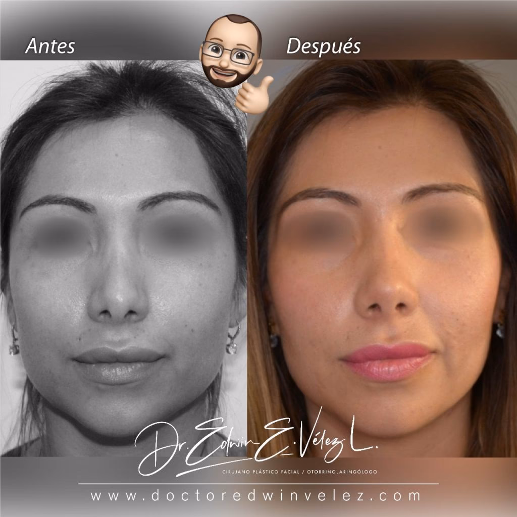 ¿Cuánto vale una rinoplastia en Pereira?