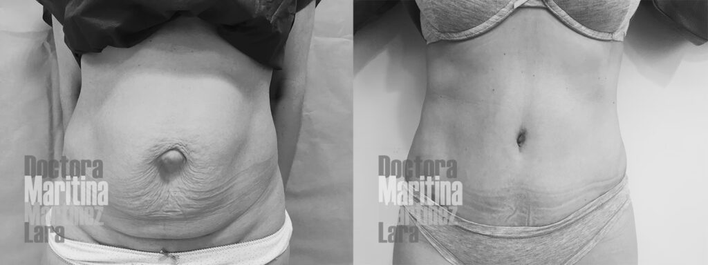 Hernia Umbilical: La Solución del Cirujano Plástico