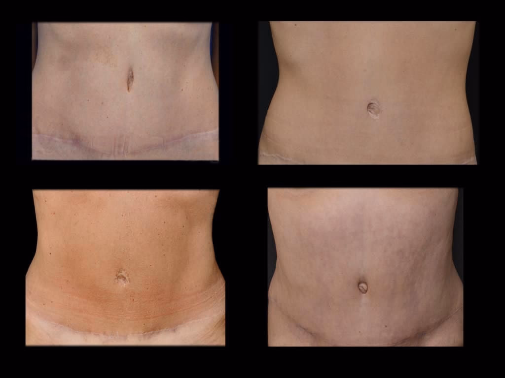 ¿Puede un cirujano plástico corregir una hernia umbilical?