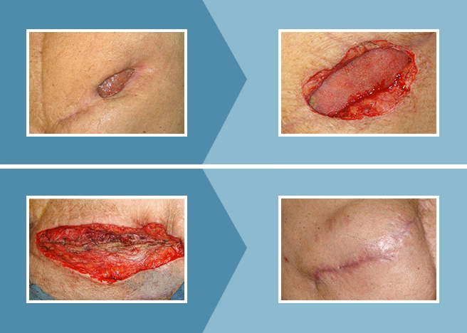 ¿Cuáles son las etapas de la cicatrización después de una cirugía?